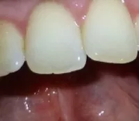 Quecksilber-Zahnfllungen